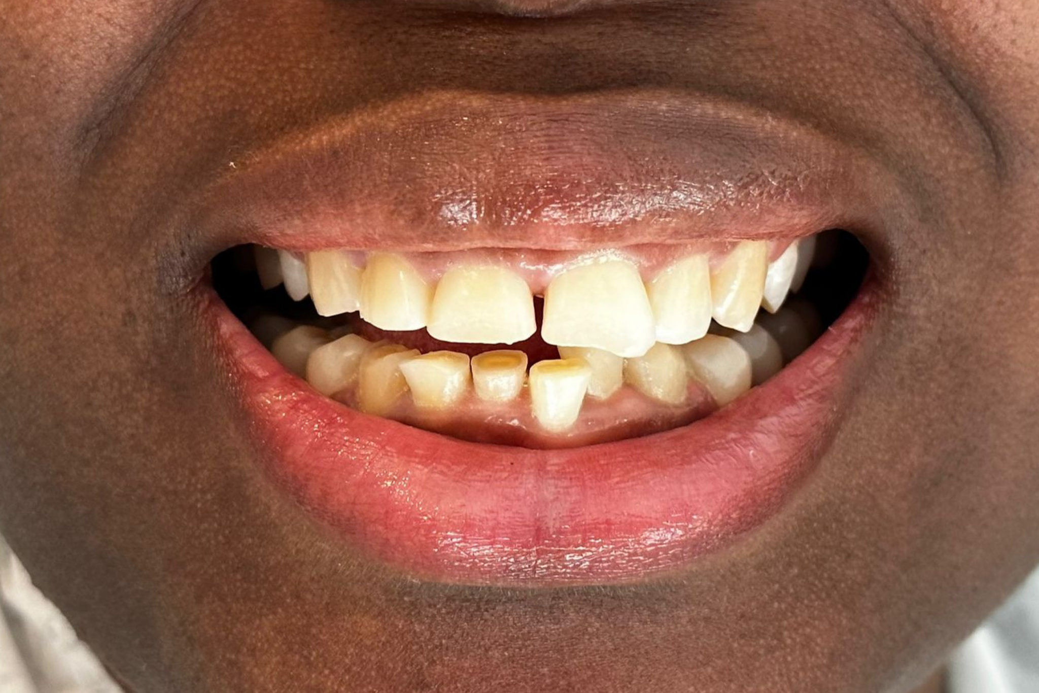 Before Composite Veneer Treatment